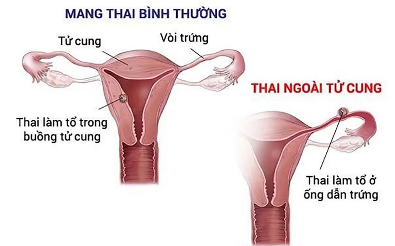 Mang thai ngoài tử cung: nguy hiểm và biện pháp phòng ngừa