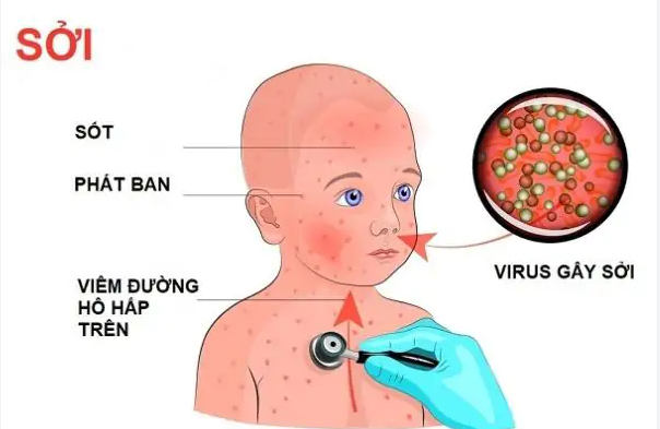 Bệnh sởi là gì? Những điều cần biết về bệnh sởi