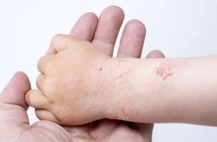 Bé bị viêm da cần làm gì để cải thiện?