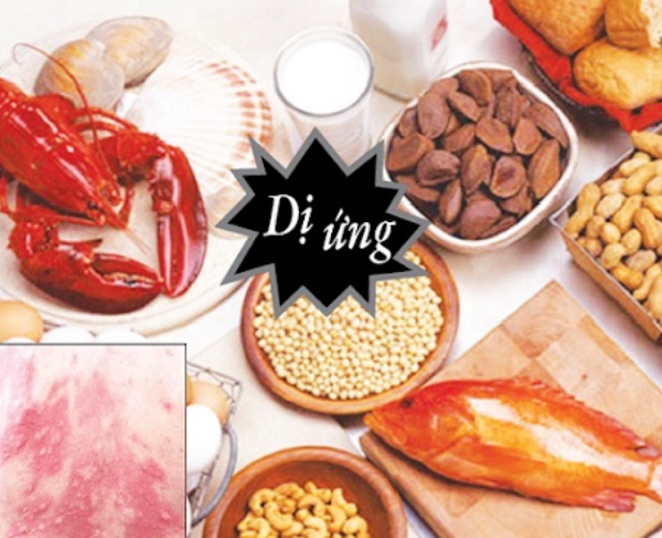 Nguy cơ cảnh báo từ dị ứng thực phẩm
