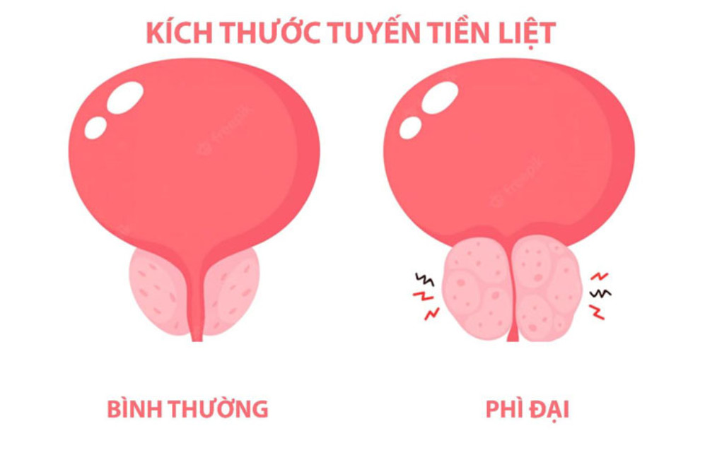 Bị phì đại tuyến tiền liệt có nên quan hệ tình dục không?