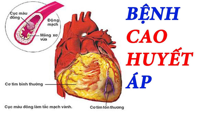 Có nên ngừng thuốc điều trị cao huyết áp khi huyết áp đã ổn định?