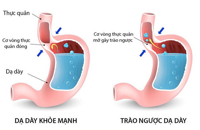 Trào Ngược Dạ Dày Thực Quản: Nguyên Nhân, Triệu Chứng, Cách Điều Trị